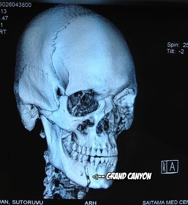 According to the x-ray, Mark Hunt did this to Stefan Struve's jaw...
