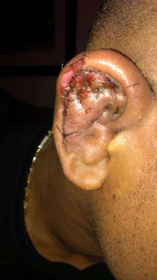 Wait, you need to see Hector Lombard's cauliflower ear before you can live life