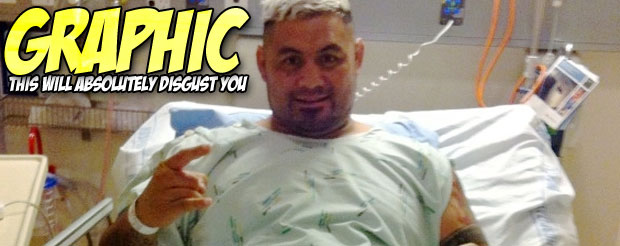 GRAPHIC: This Mark Hunt staph infection video will make you projectile vomit