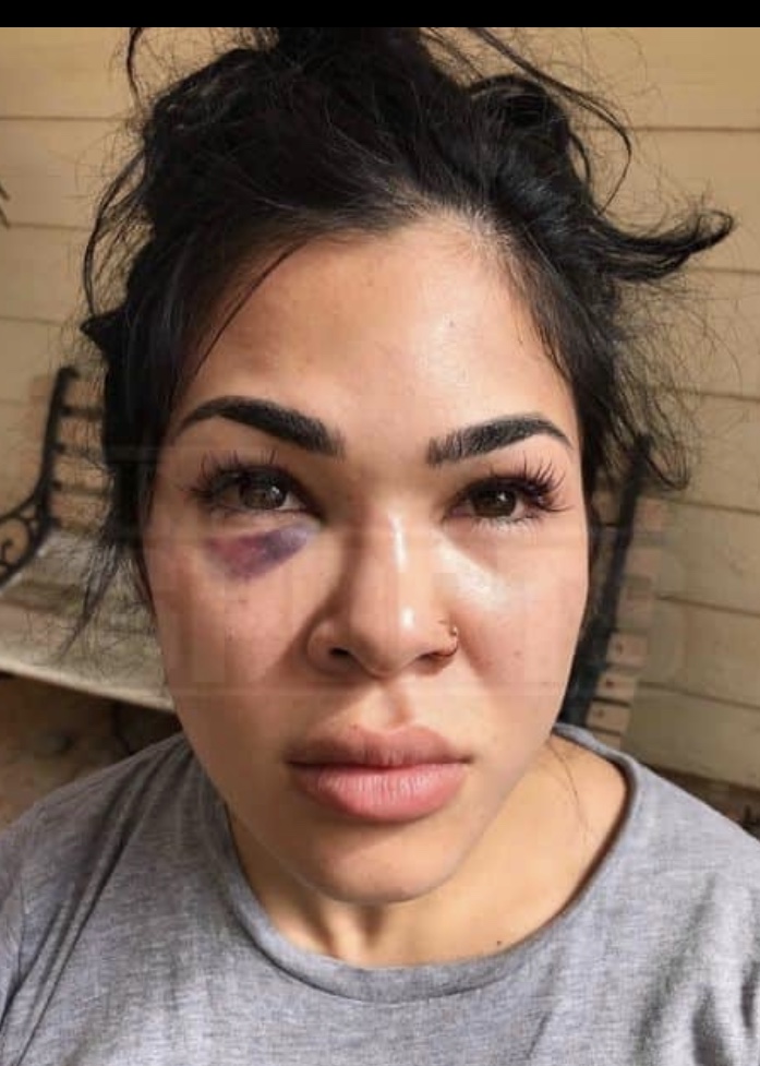 IMG_2222 New pics emerge of Rachael Ostovich & her domestic violence injuries