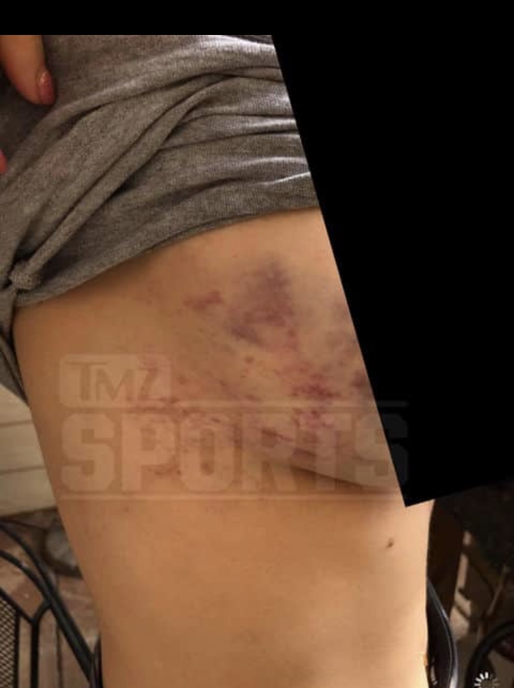 IMG_2224 New pics emerge of Rachael Ostovich & her domestic violence injuries