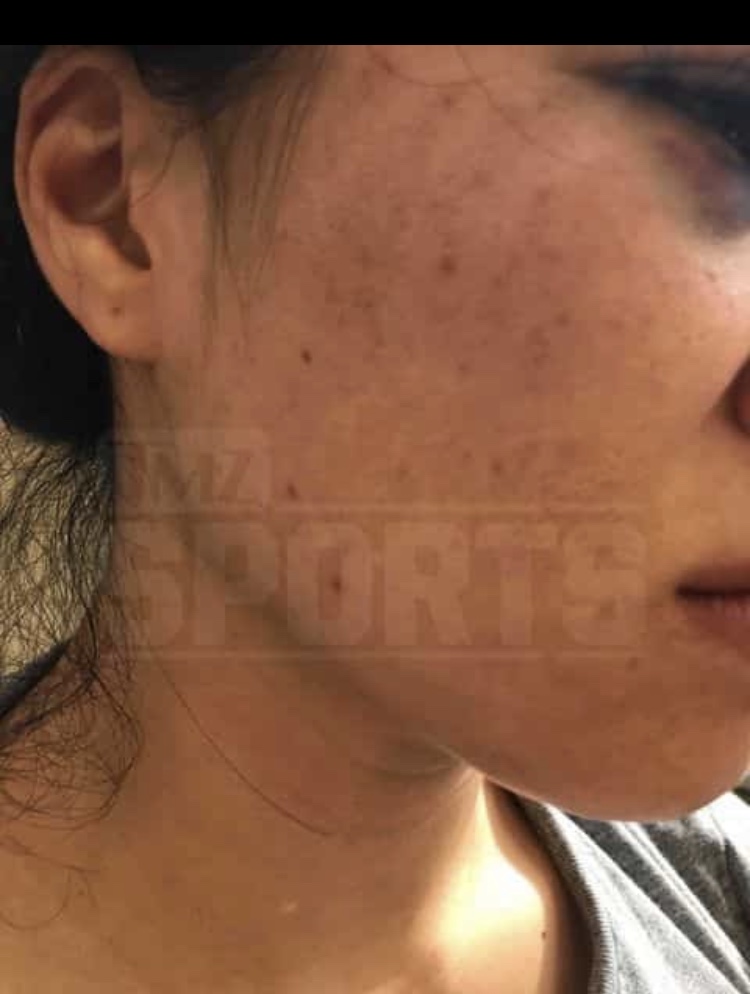 IMG_2225 New pics emerge of Rachael Ostovich & her domestic violence injuries