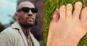 Conor McGregor Toe Injury