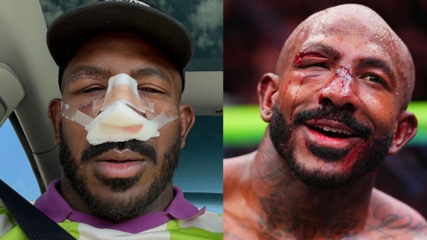 Khalil Rountree Jr Nose Surgery